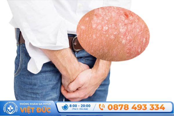 Triệu chứng nhận biết nấm ngứa ở tinh hoàn