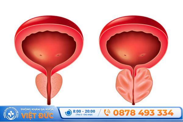 Tuyến tiền liệt ở nam giới