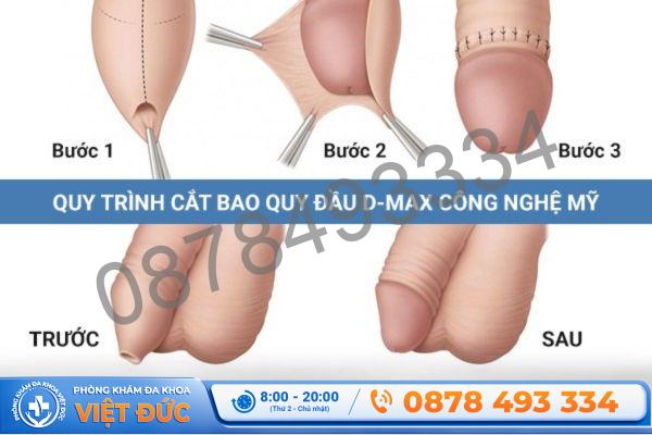 Phòng khám Việt Đức Bắc Ninh 30 Quy trình cắt bao quy đầu uy tín bằng công nghệ hiện đại